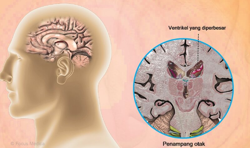 Apa Itu Penyakit Huntington Yuk Kenali Dulu Penyebabnya Sehatpoin 8172